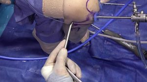 Cómo reparar los meniscos de la rodilla